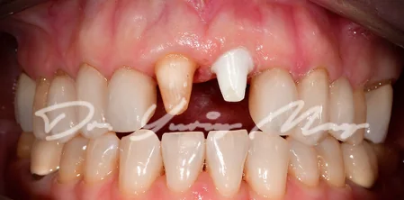 Anterior one-piece zirconia implant case 01 at placement