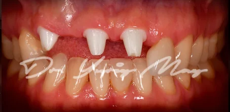 Anterior one-piece zirconia implant case 02 at placement