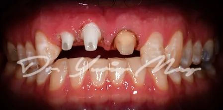 Anterior one-piece zirconia implant case 03 at placement