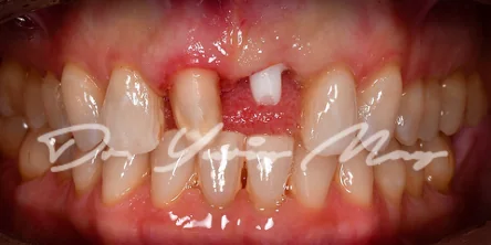 Anterior one-piece zirconia implant case 04 at placement