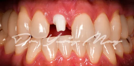 Anterior one-piece zirconia implant case 05 at placement