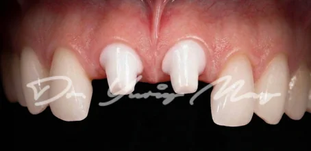 Anterior one-piece zirconia implant case 06 at placement