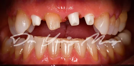 Anterior one-piece zirconia implant case 07 at placement