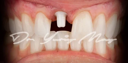 Anterior one-piece zirconia implant case 08 at placement