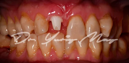 Anterior one-piece zirconia implant case 09 at placement