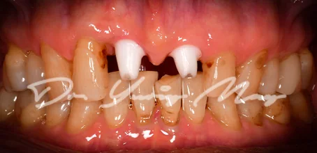 Anterior one-piece zirconia implant case 10 at placement