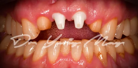 Anterior one-piece zirconia implant case 11 at placement