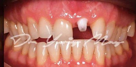 Anterior one-piece zirconia implant case 12 at placement