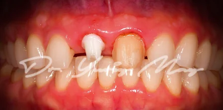 Anterior one-piece zirconia implant case 13 at placement