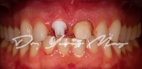 Anterior one-piece zirconia implant case 14 at placement