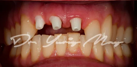 Anterior one-piece zirconia implant case 15 at placement