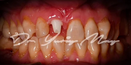Anterior one-piece zirconia implant case 16 at placement