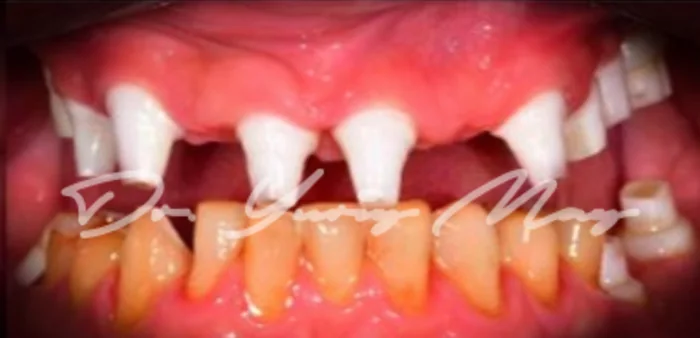 Full-arch zirconia implant case 01 at placement: zirconia implant abutments in place