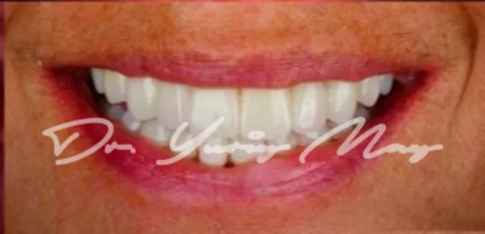 Full-arch zirconia implant case 01 restored