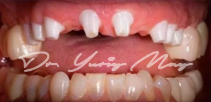 Full-arch zirconia implant case 02 at placement: zirconia implant abutments in place