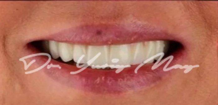 Full-arch zirconia implant case 02 restored