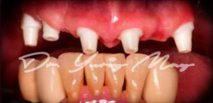 Full-arch zirconia implant case 03 at placement: zirconia implant abutments in place
