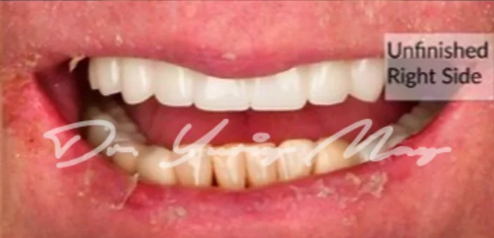 Full-arch zirconia implant case 03 restored