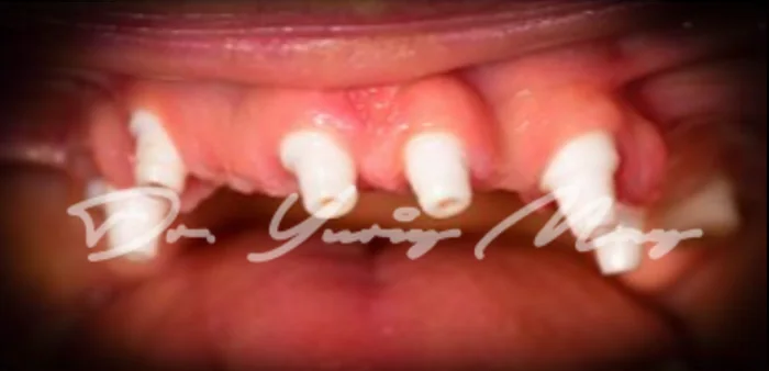 Full-arch zirconia implant case 04 at placement: zirconia implant abutments in place
