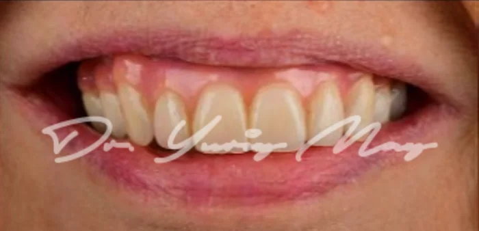 Full-arch zirconia implant case 04 restored