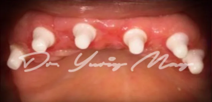 Full-arch zirconia implant case 05 at placement: zirconia implant abutments in place