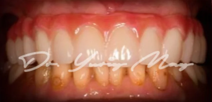 Full-arch zirconia implant case 05 restored