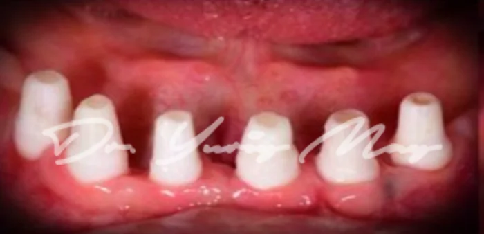 Full-arch zirconia implant case 06 at placement: zirconia implant abutments in place