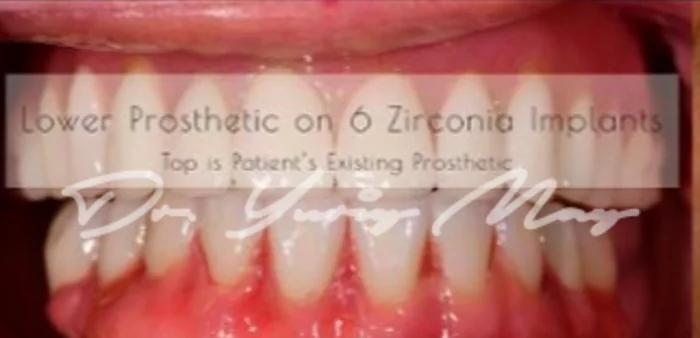 Full-arch zirconia implant case 06 restored