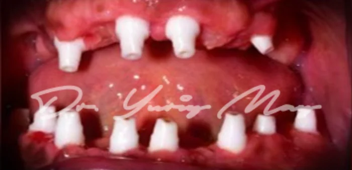 Full-arch zirconia implant case 07 at placement: zirconia implant abutments in place
