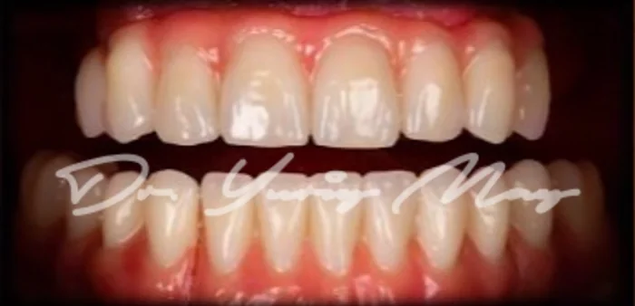 Full-arch zirconia implant case 07 restored