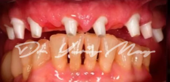 Full-arch zirconia implant case 08 at placement: zirconia implant abutments in place