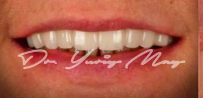 Full-arch zirconia implant case 08 restored