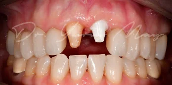 Zirconia implant case 01 at placement: zirconia implant abutments in place