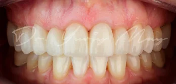 Zirconia implant case 01 restored