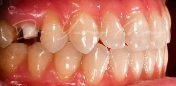 Zirconia implant case 02 at placement: zirconia implant abutments in place
