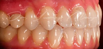 Zirconia implant case 02 restored