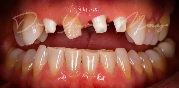 Zirconia implant case 03 at placement: zirconia implant abutments in place