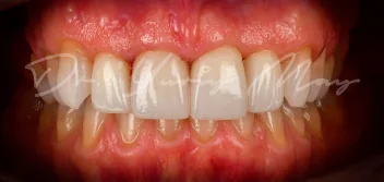 Zirconia implant case 03 restored