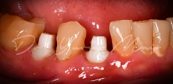 Zirconia implant case 04 at placement: zirconia implant abutments in place