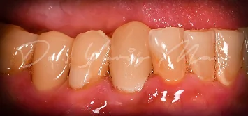 Zirconia implant case 04 restored