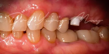 Zirconia implant case 05 at placement: zirconia implant abutments in place