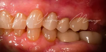 Zirconia implant case 05 restored
