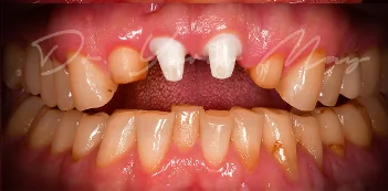 Zirconia implant case 06 at placement: zirconia implant abutments in place