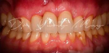 Zirconia implant case 06 restored