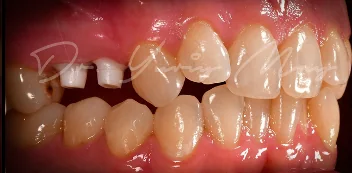 Zirconia implant case 07 at placement: zirconia implant abutments in place