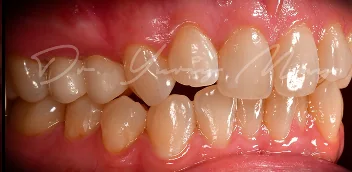 Zirconia implant case 07 restored