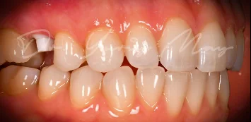 Zirconia implant case 08 at placement: zirconia implant abutments in place