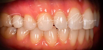 Zirconia implant case 08 restored