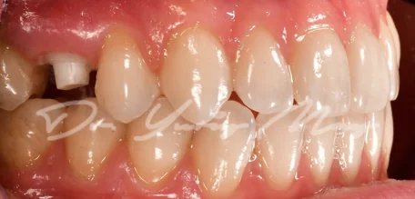 Posterior zirconia implant case 01 at placement