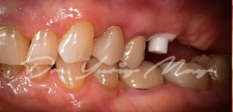Posterior zirconia implant case 02 at placement
